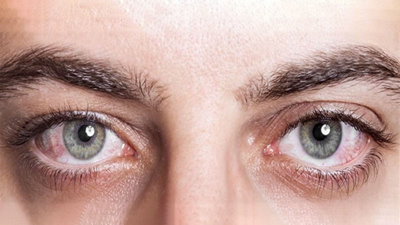 Olhos Irritados De Uma Menina Que Ficasse Doente Com Conjuntivite Foto de  Stock - Imagem de adolescente, inchado: 146506816