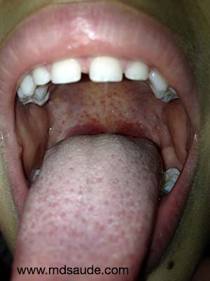 Bolinhas brancas na garganta: Como tirar e evitar essas