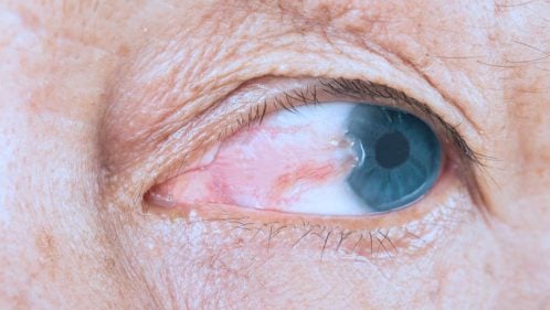 Foto de Doença De Terçol No Olho De Uma Mulher Branca e mais fotos