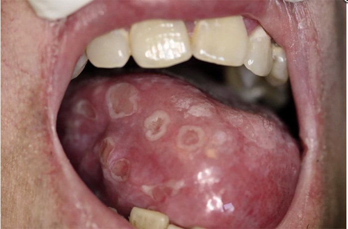 Syphilis Chancre Tongue