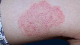 Roseola Exantema Subito Sintomas E Tratamento Md Saude