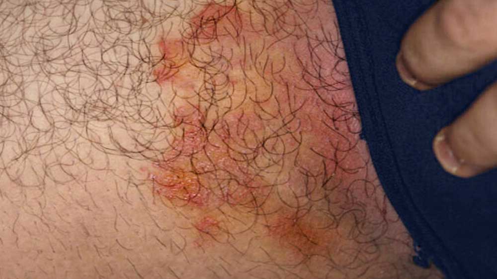 Micose na virilha (tinea cruris): sintomas e tratamento