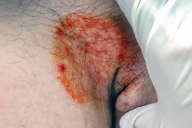 Micose na virilha: sintomas, causas e tratamento - Tua Saúde