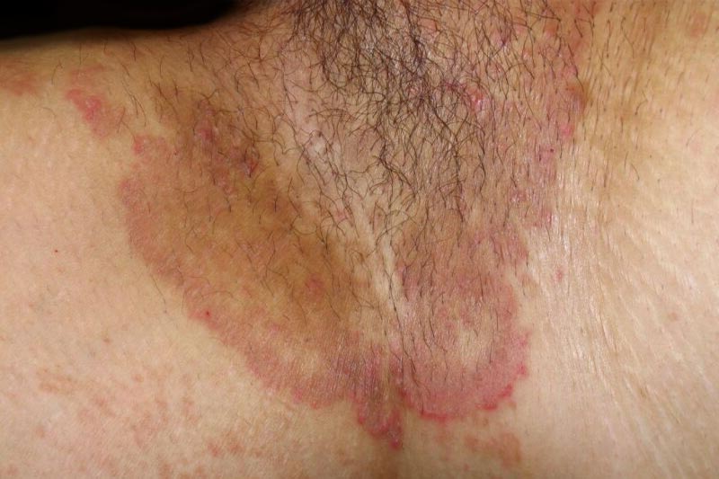 Tinea Cruris (prurido Jock) - Distúrbios dermatológicos - Manuais