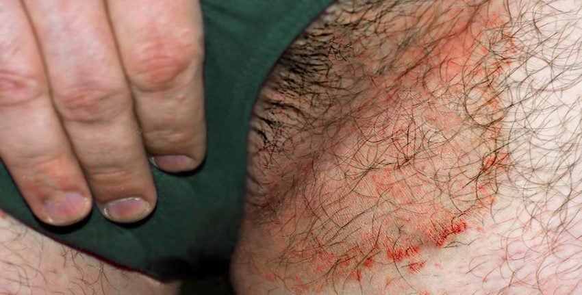 El Intertrigo es una irritación y erosión de la piel en zonas