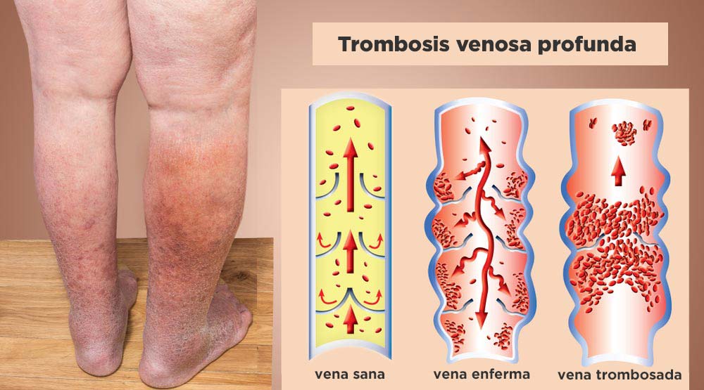 Trombosis venosa profunda: qué es, síntomas y tratamiento