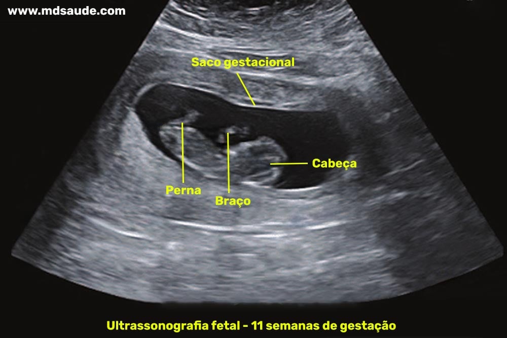 Ultrassom com 11 semanas de gravidez