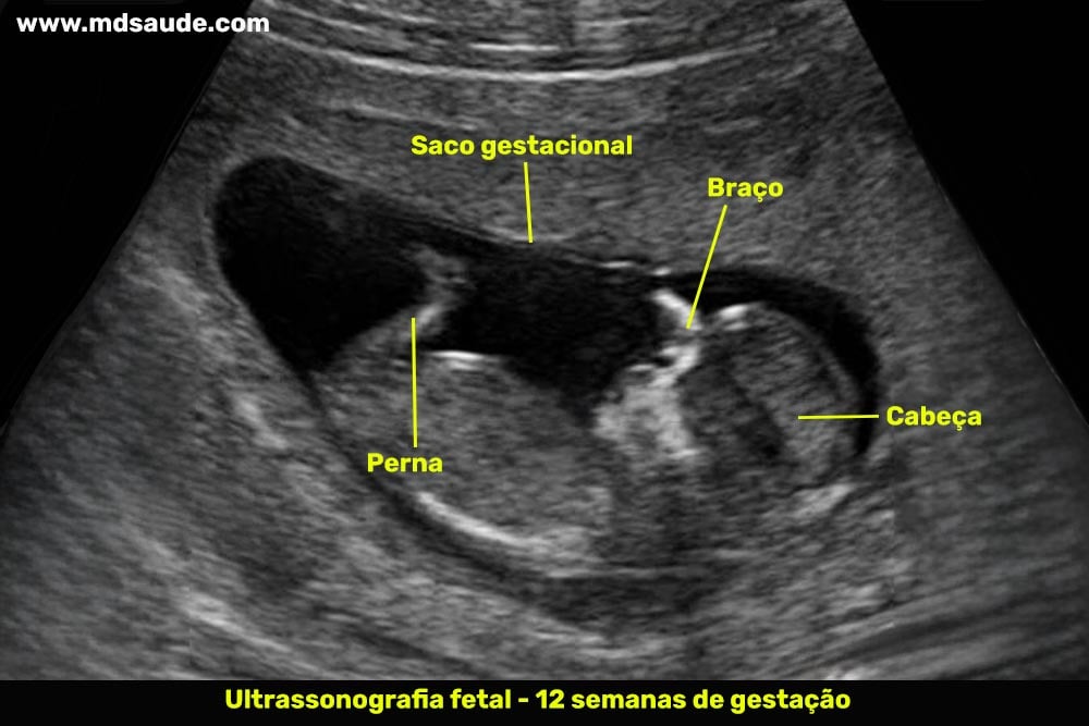 Ultrassom com 12 semanas de gravidez