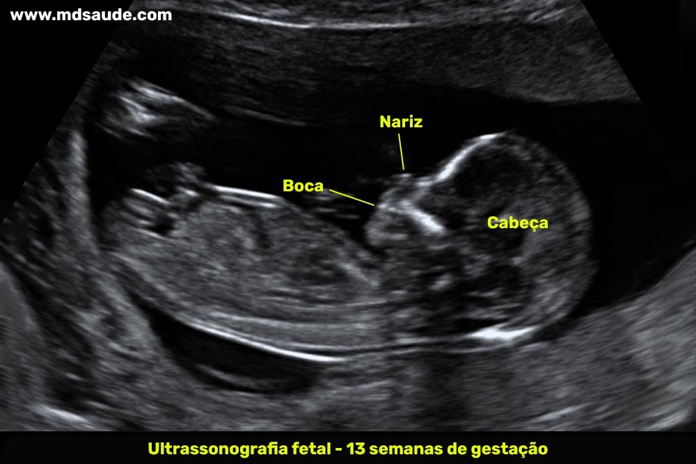 Ultrassom com 13 semanas de gravidez