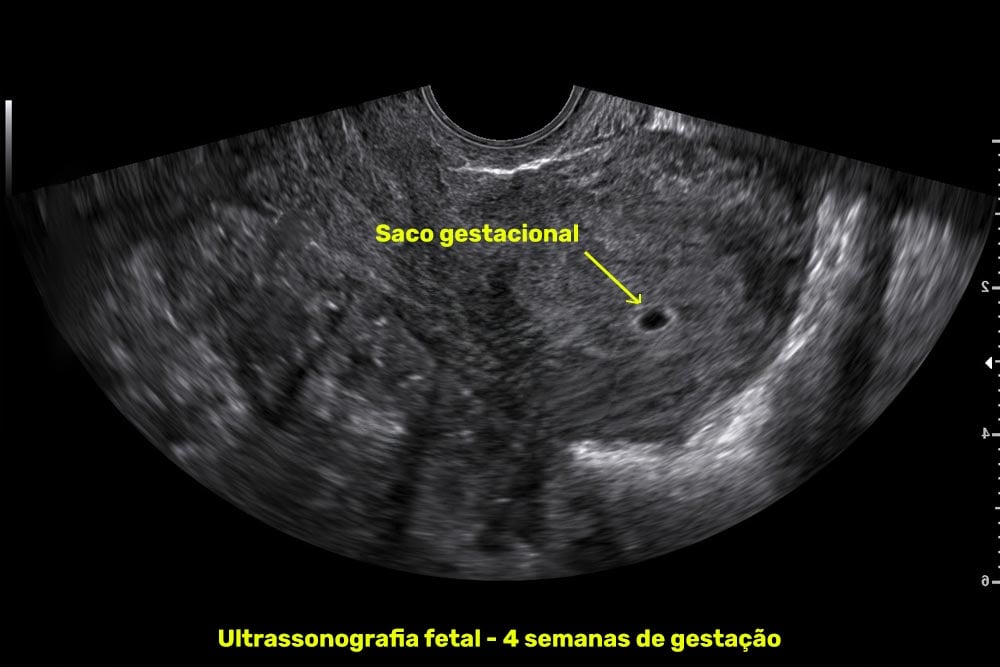 Ultrassom com 4 semanas de gestação