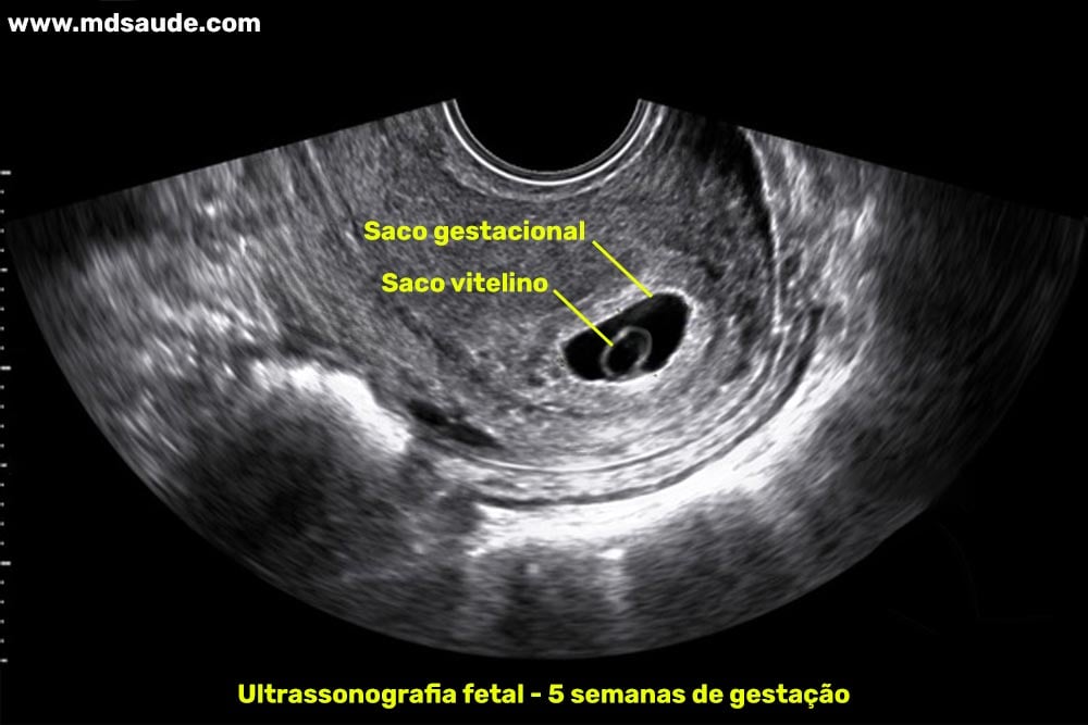 Ultrassom 5 semanas de gravidez