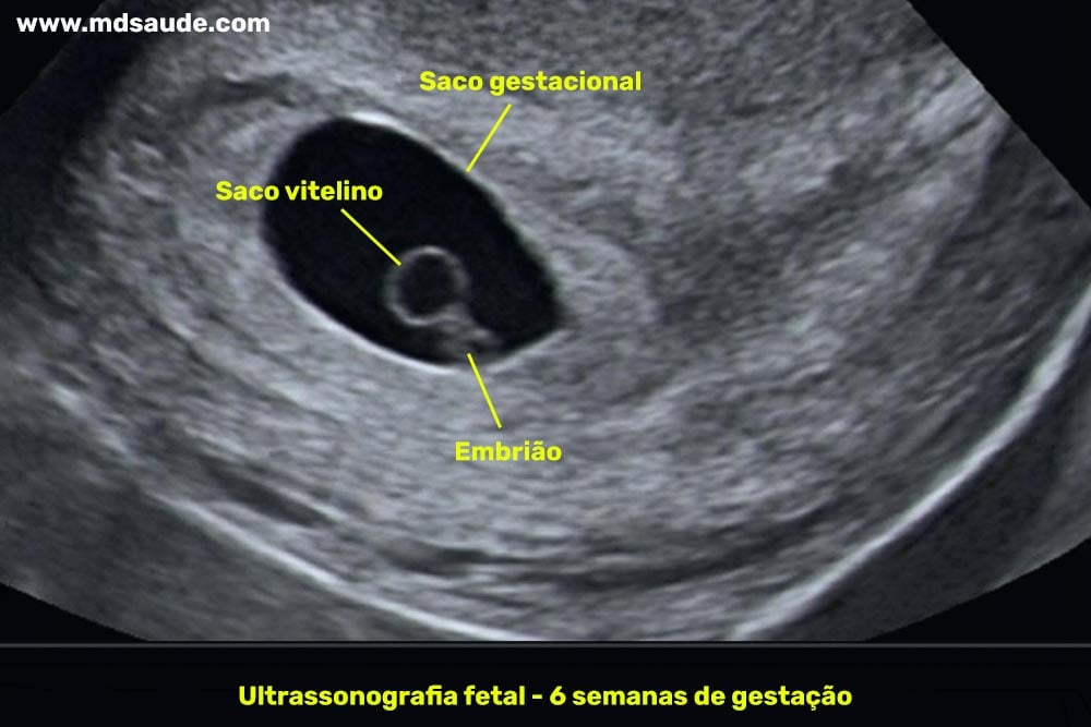 Ultrassom com 6 semanas de gestação