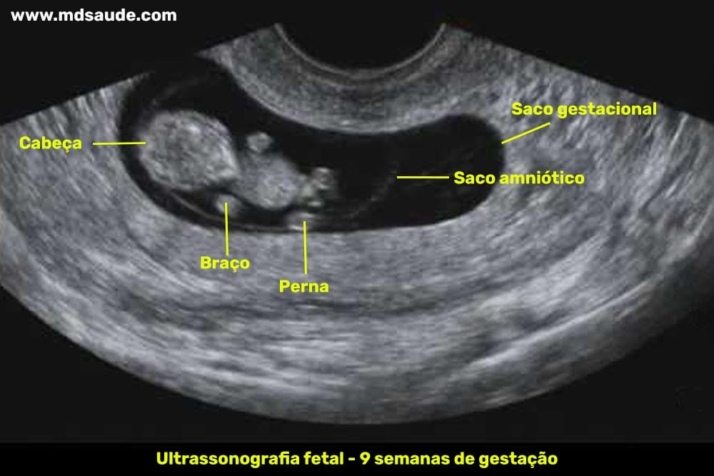 Ultrassom com 9 semanas de gravidez