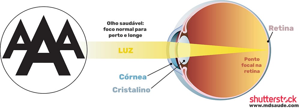 Formação do foco em olho saudável